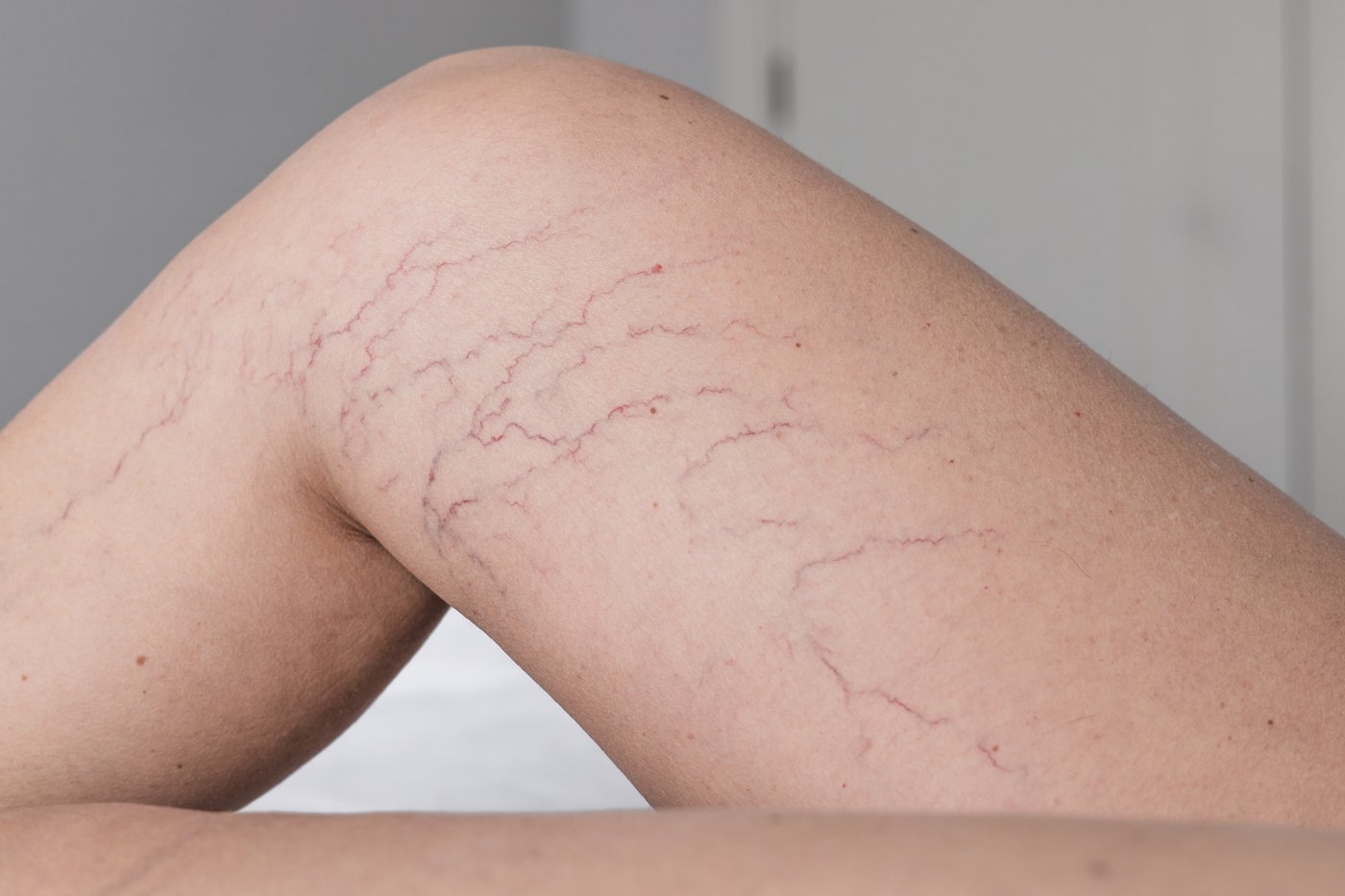 Piernas con arañitas vasculares visibles bajo la piel