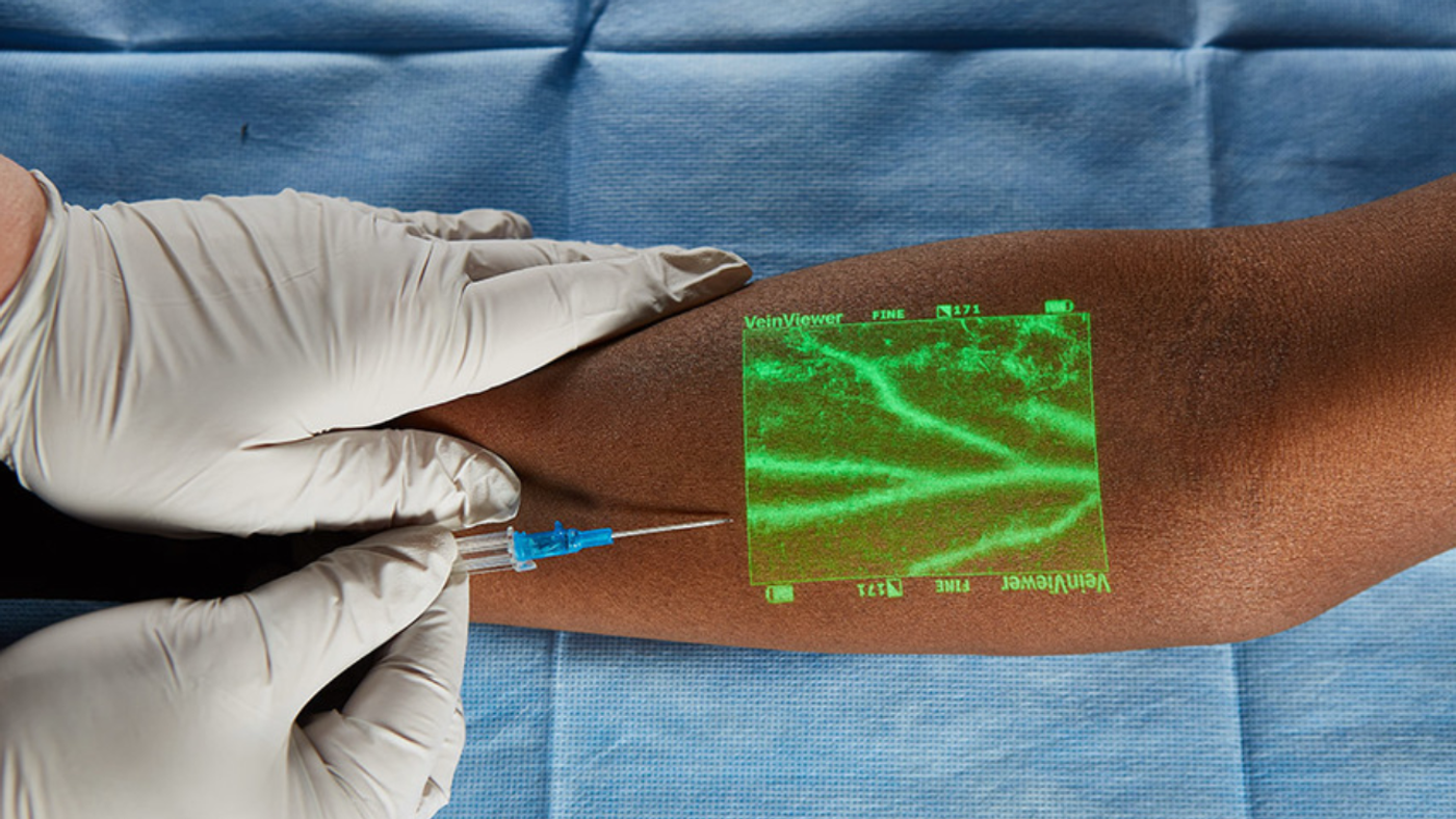 ¿Qué es el Vein Viewer y cómo mejora el tratamiento de várices?