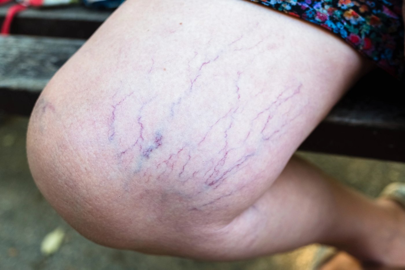 Celulitis y várices: ¿están relacionadas?