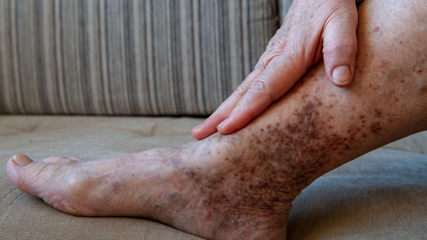 Cáncer y trombosis: por qué van juntos y cómo se previene