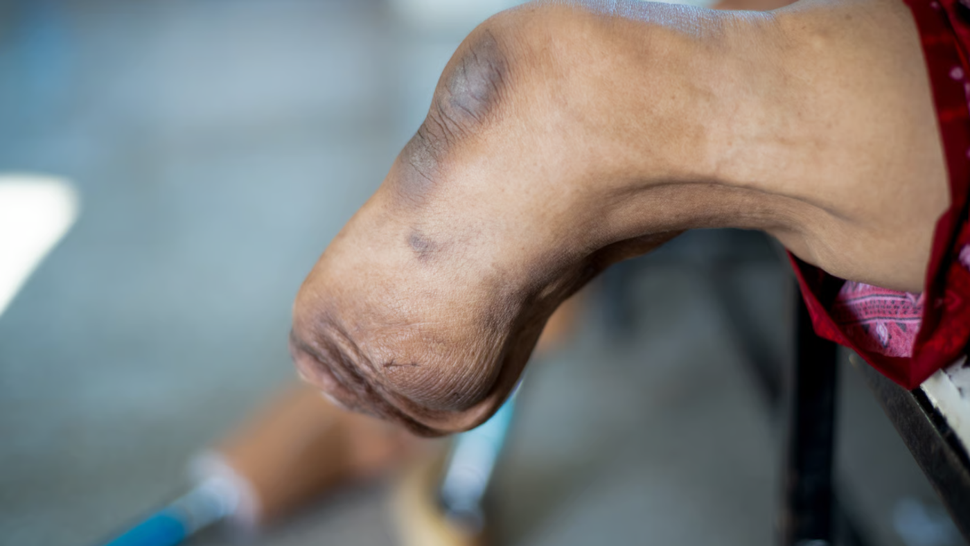 Amputación por diabetes: por qué ocurre y cómo reducir el riesgo a tiempo