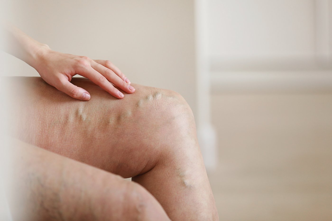Mujer con piernas más ligeras tras mejorar la circulación venosa