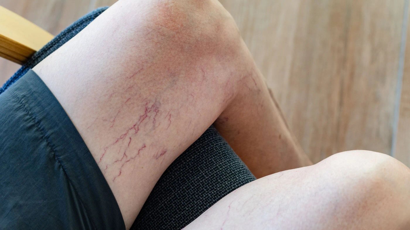 ¿Por qué me duelen las piernas? 7 causas vasculares que debes conocer