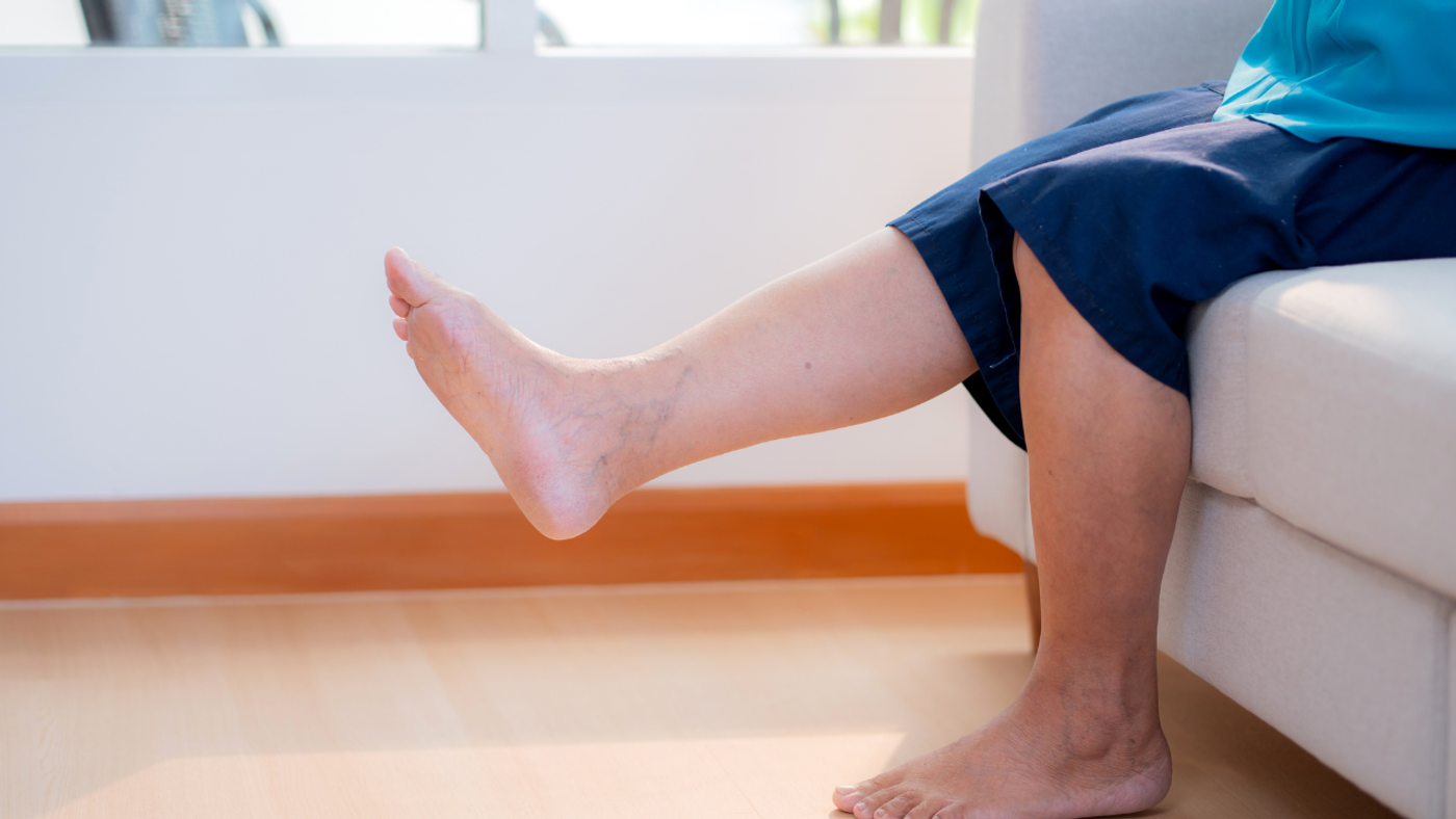 Person seated on a sofa with one leg extended, showing visible varicose veins on the calf and ankle.