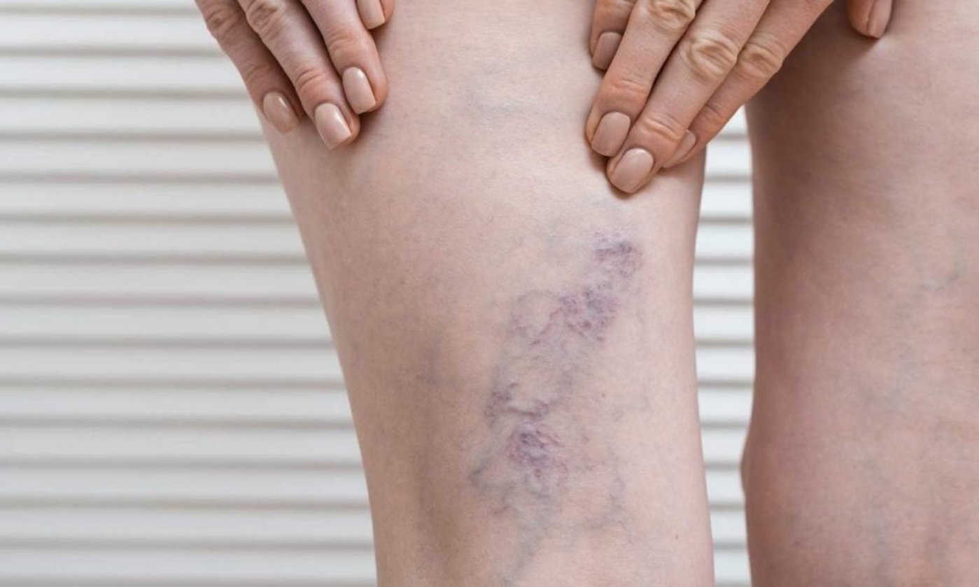 ¿Cómo saber si tengo mala circulación? 9 señales en tus piernas