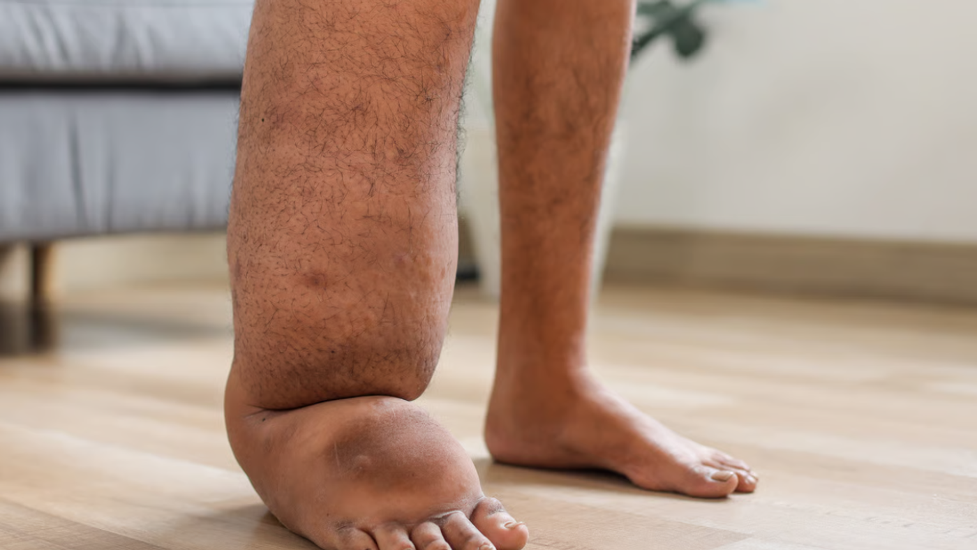 ¿Qué es el linfedema y cómo se trata?