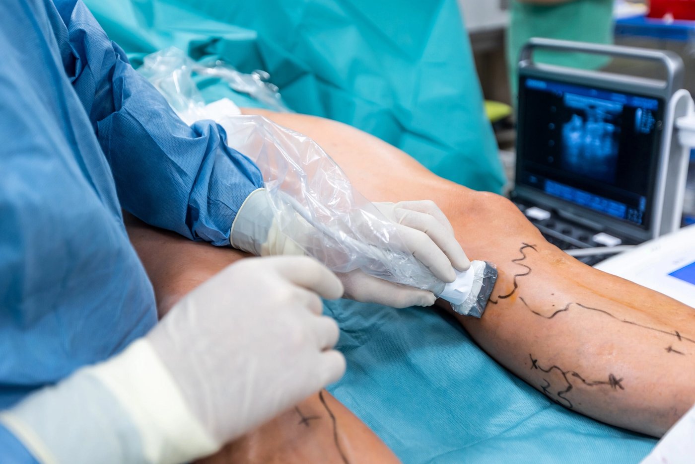 Diabetes y circulación: cómo la diabetes afecta tus venas y arterias