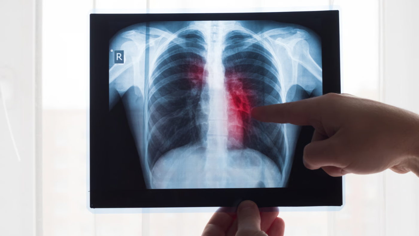 Embolia pulmonar: cuando un coágulo de la pierna viaja al pulmón