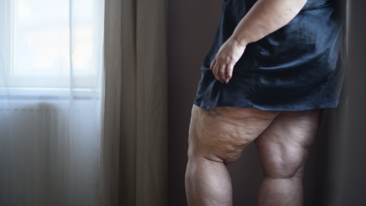 ¿Linfedema o lipedema? La confusión que retrasa tratamientos por años