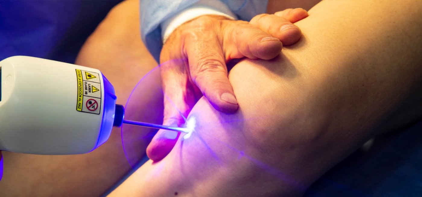 Escleroterapia vs. láser: ¿cuál es mejor para tus várices?