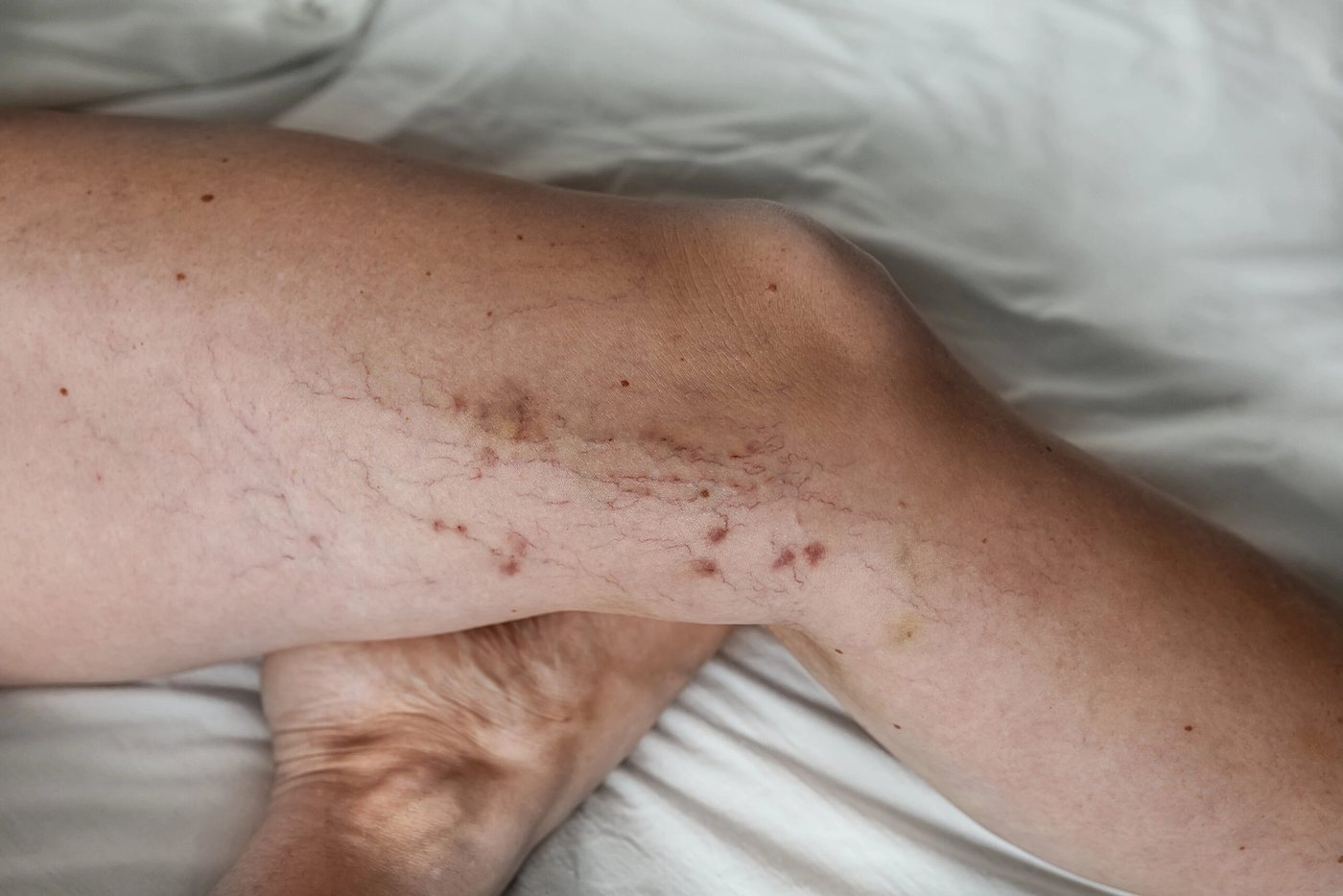 Síndrome de piernas inquietas: ¿tiene relación con las várices?