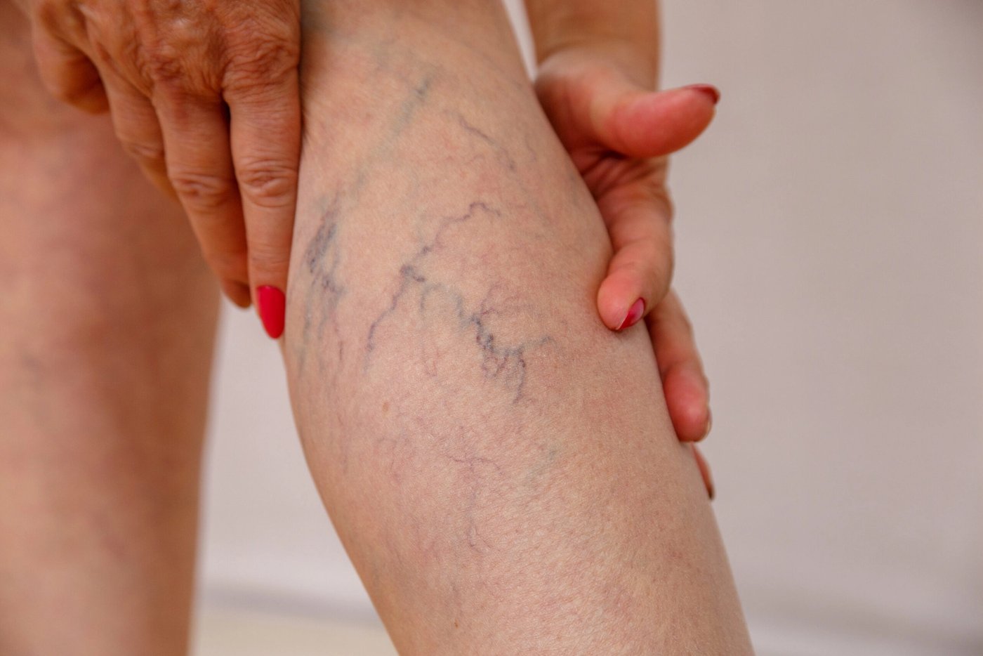 ¿Cómo prevenir trombosis después de una cirugía?