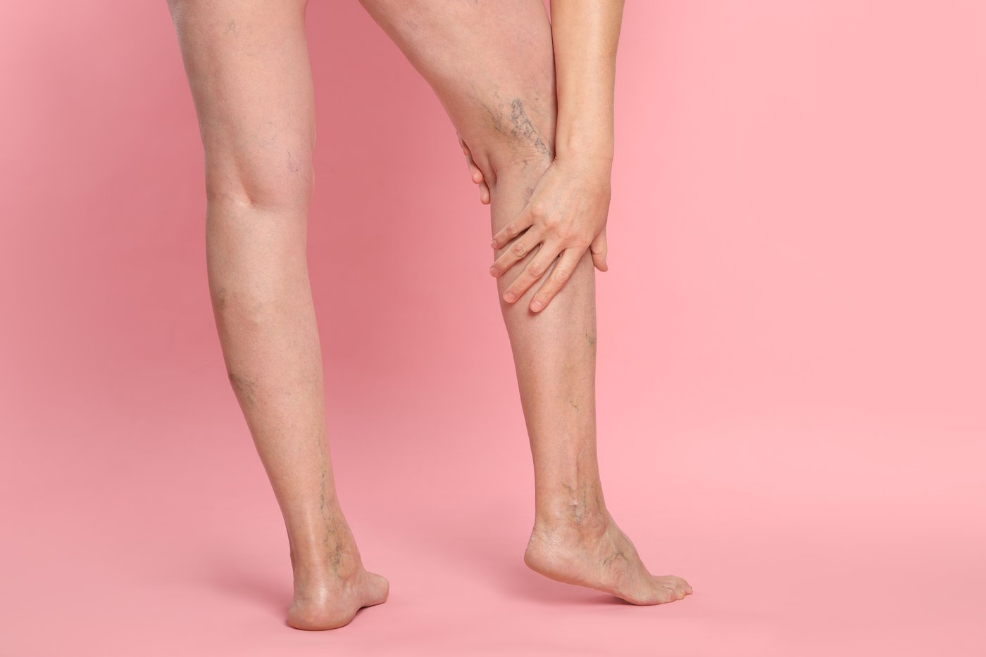 Piernas con várices y arañitas vasculares visibles