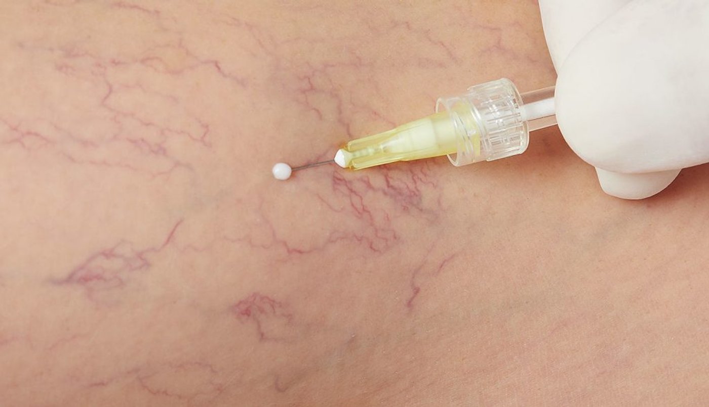 ¿Qué es la escleroterapia con espuma y para qué sirve?