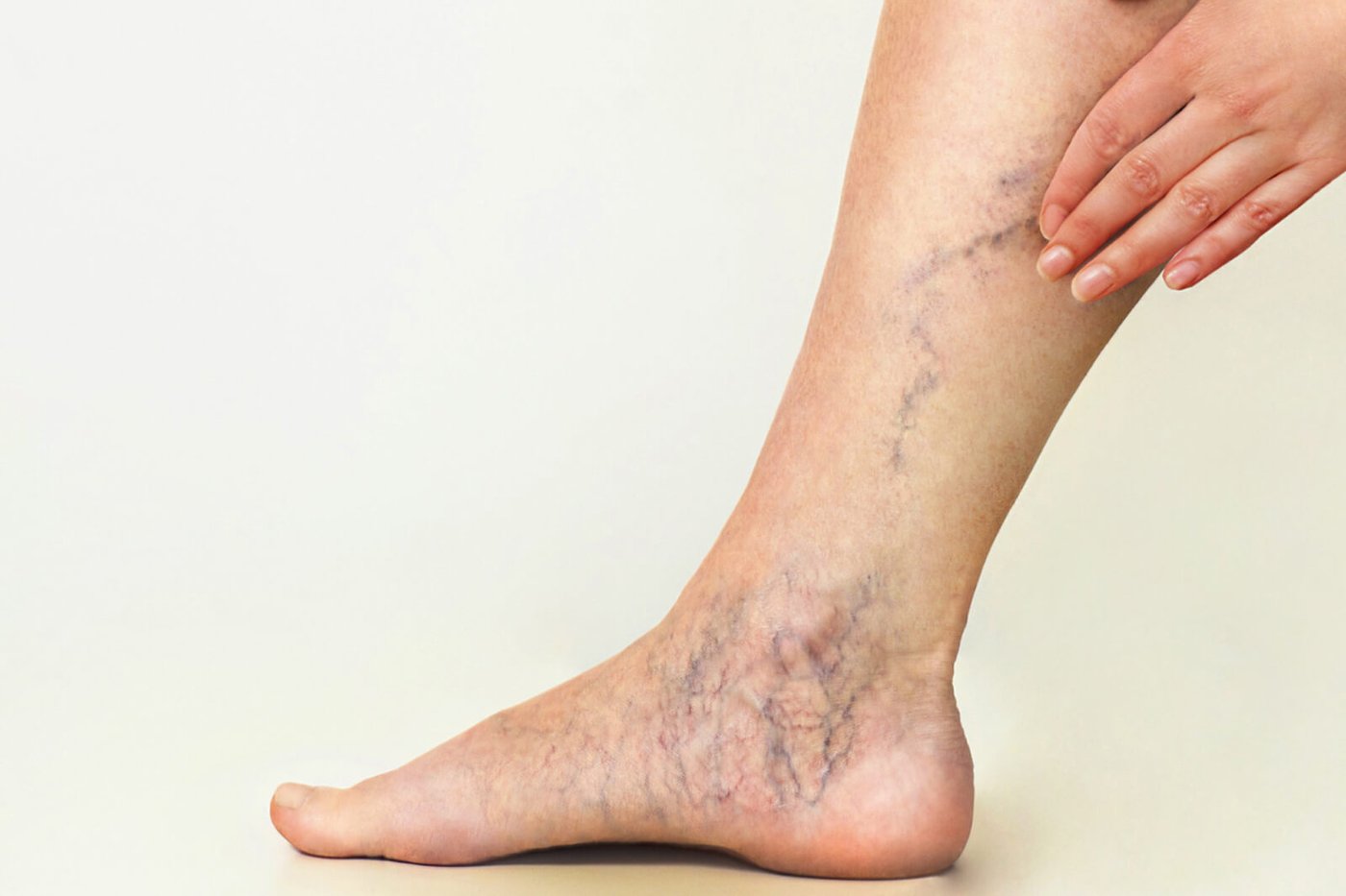 Arañitas vasculares en las piernas: por qué salen y cómo quitarlas