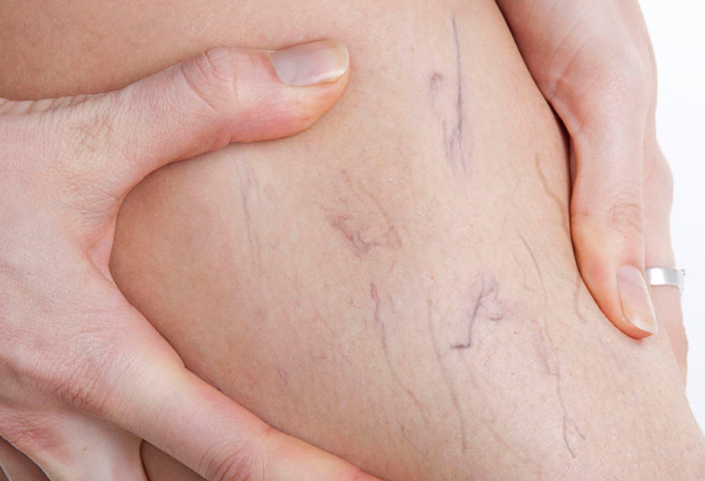 ¿Por qué me salen venas moradas en las piernas?