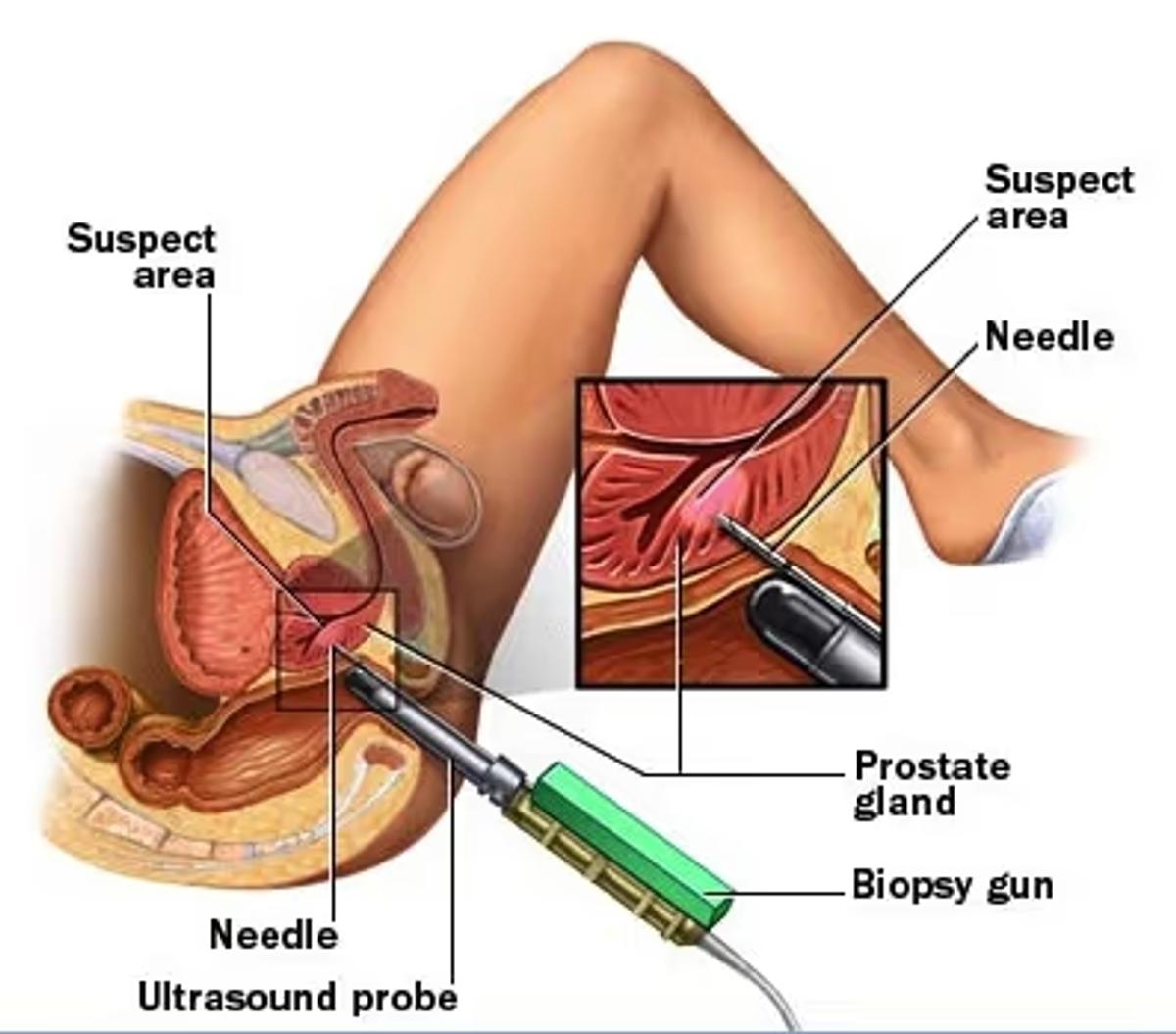 Transrectal Biopsy