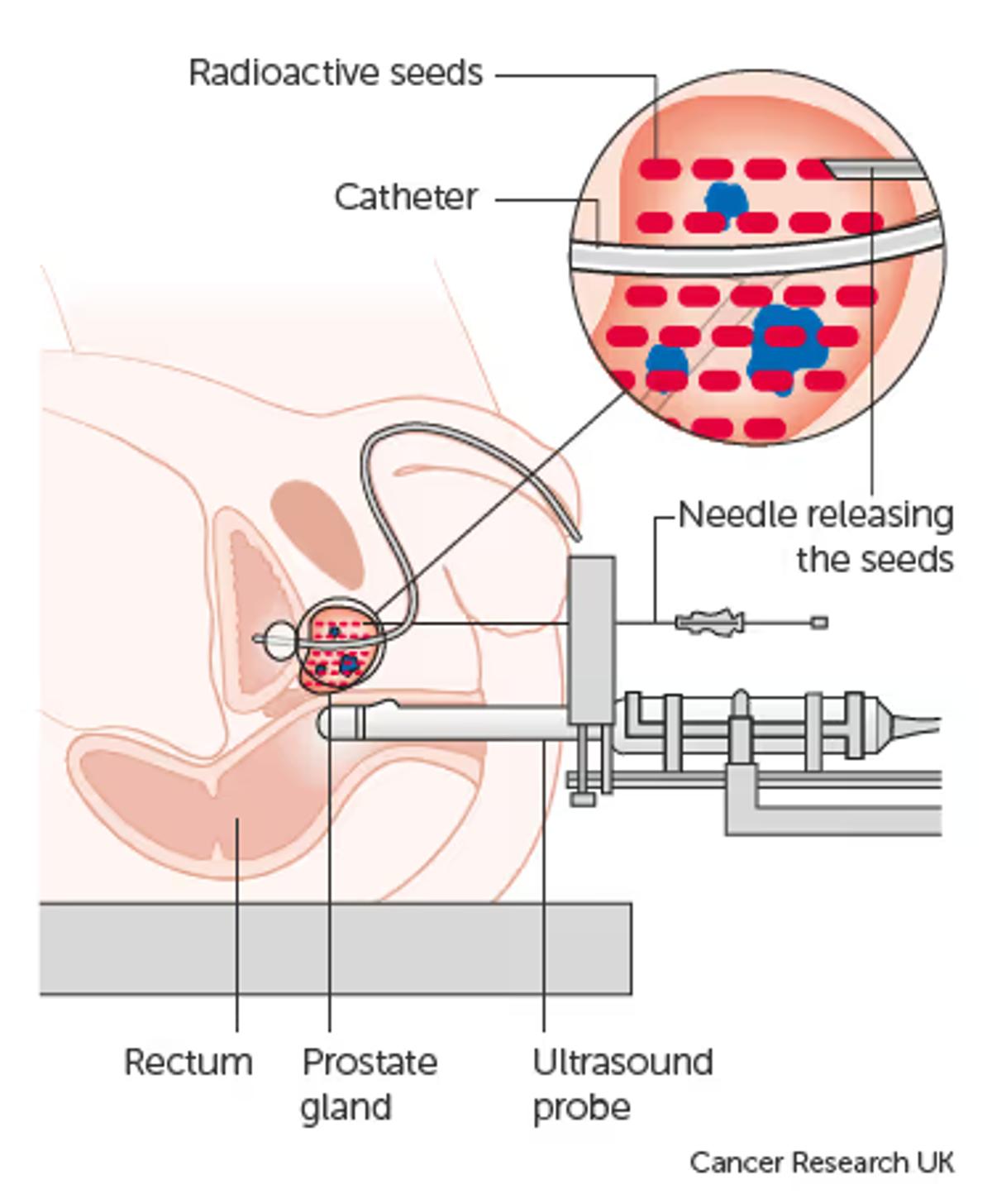 Prostate cancer treatment method for brachytherapy