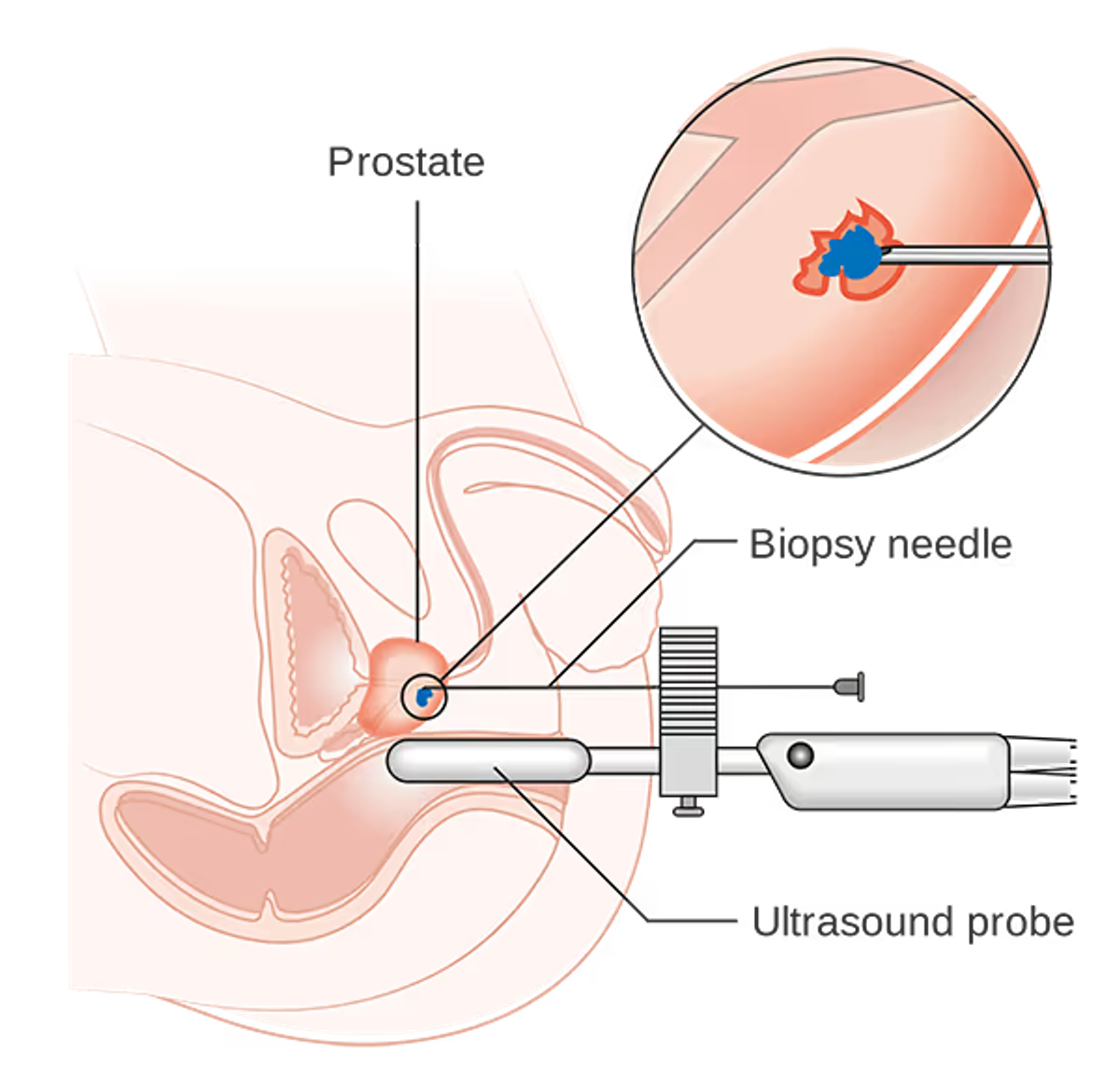 Transperineal biopsy
