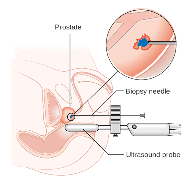 Transperineal biopsy