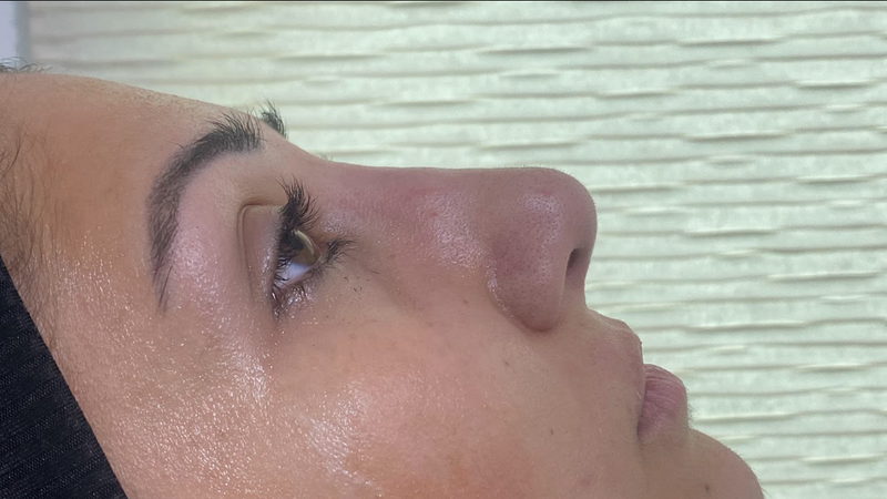 Refined Nose Shape Without Surgery after treatment