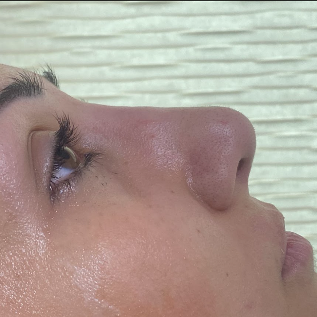 Side profile of a woman's nose after a non-surgical rhinoplasty treatment in Ajax