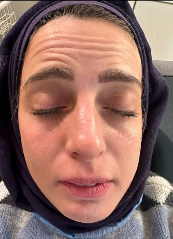 Botox — Smoother, Youthful-Looking Skin before treatment