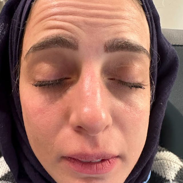 front profile of a woman's face before forehead botox treatment in Ajax