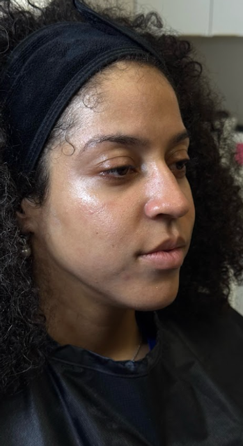Side profile of a woman's face after a Glass Facial and dermaplaning treatment in Ajax