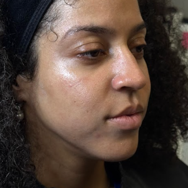 Side profile of a woman's face after a Glass Facial and dermaplaning treatment in Ajax