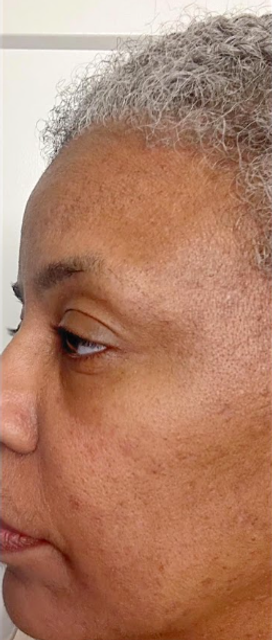 Smoother-looking skin after treatment