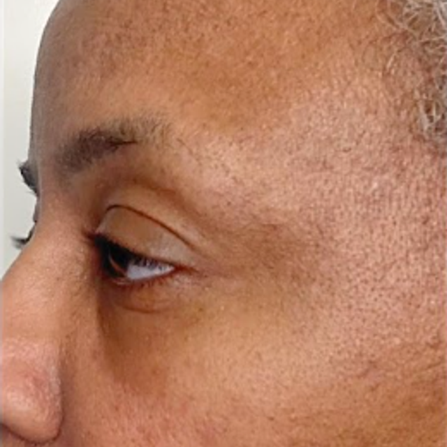 Smoother-looking skin after treatment