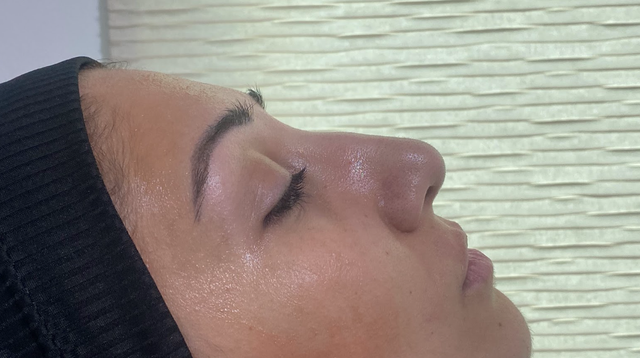 Side profile of a woman's nose before a non-surgical rhinoplasty treatment in Ajax
