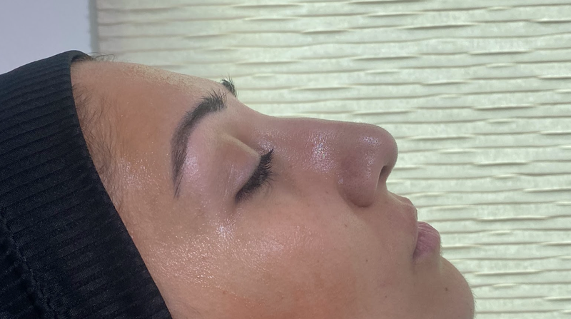 Refined Nose Shape Without Surgery before treatment