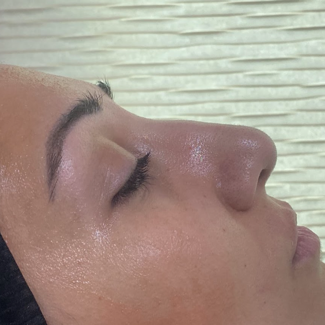 Side profile of a woman's nose before a non-surgical rhinoplasty treatment in Ajax