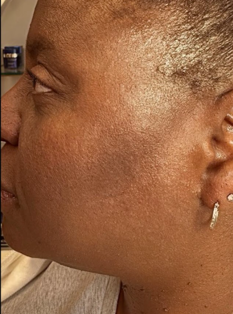 Close-up side profile of a patient with DPN spots on the cheek after removal treatment in Ajax