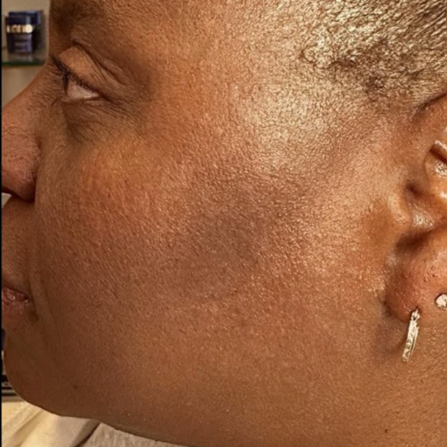 Close-up side profile of a patient with DPN spots on the cheek after removal treatment in Ajax