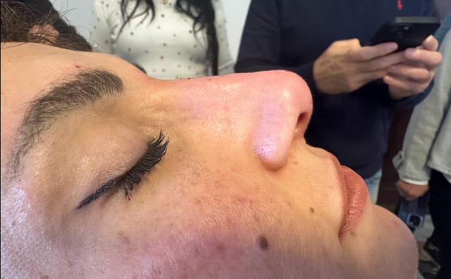 Side profile of a woman's nose after a non-surgical rhinoplasty treatment in Ajax