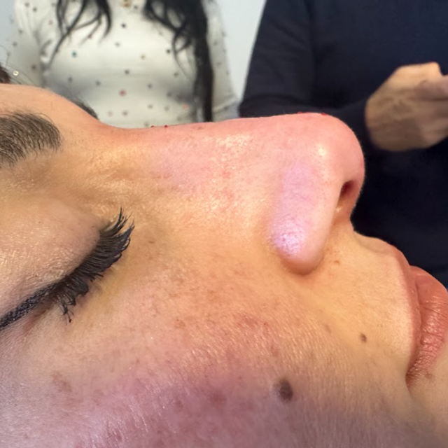 Side profile of a woman's nose after a non-surgical rhinoplasty treatment in Ajax