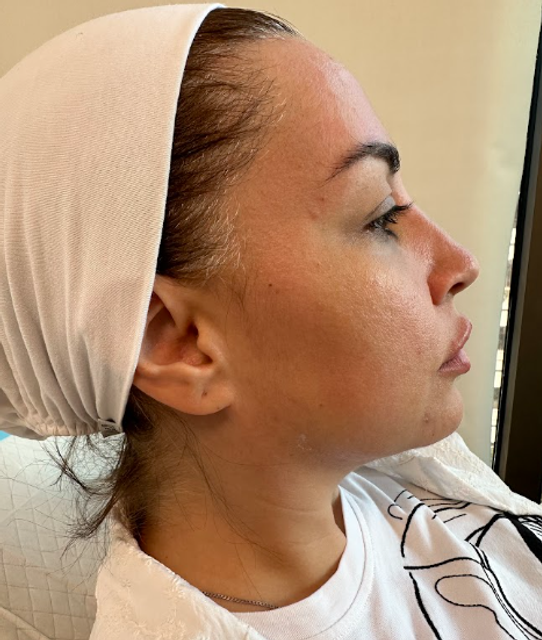 Side profile of a woman's face before a facial dermal filler treatment in Ajax
