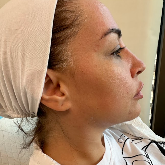 Side profile of a woman's face before a facial dermal filler treatment in Ajax
