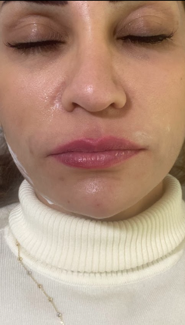 front profile of a woman's face before a lip filler treatment in Ajax