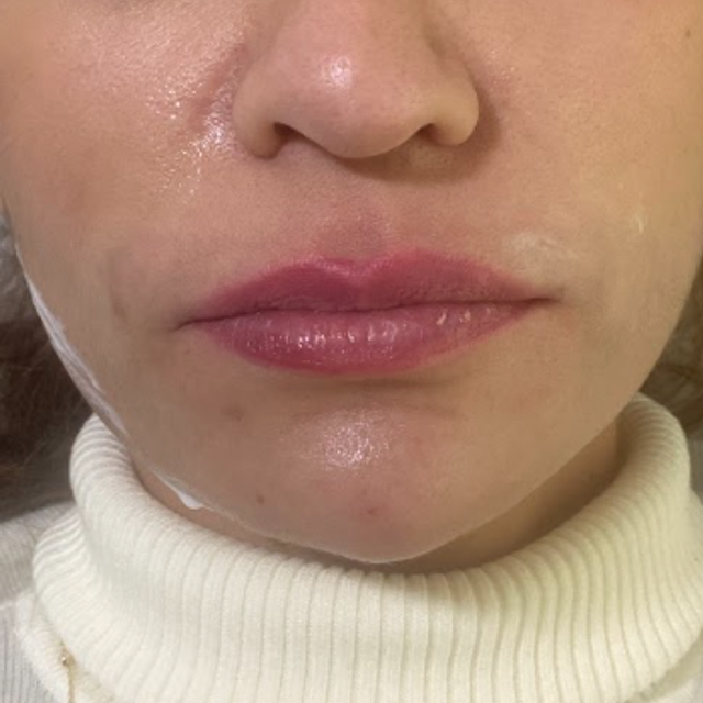 front profile of a woman's face before a lip filler treatment in Ajax