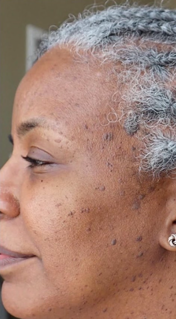 Visible skin tags before treatment