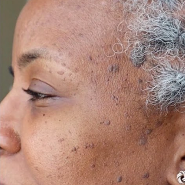 Visible skin tags before treatment