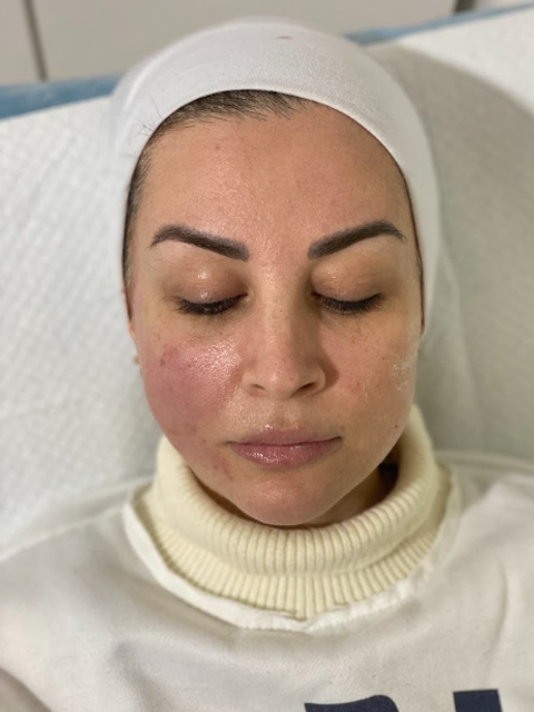 Woman with eyes closed wearing a white headband, shown before thread lift treatment in Ajax.