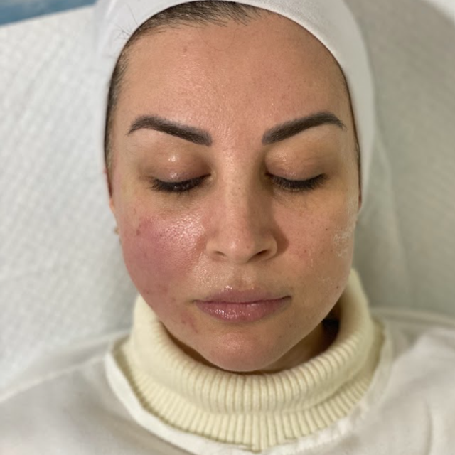 Woman with eyes closed wearing a white headband, shown before thread lift treatment in Ajax.