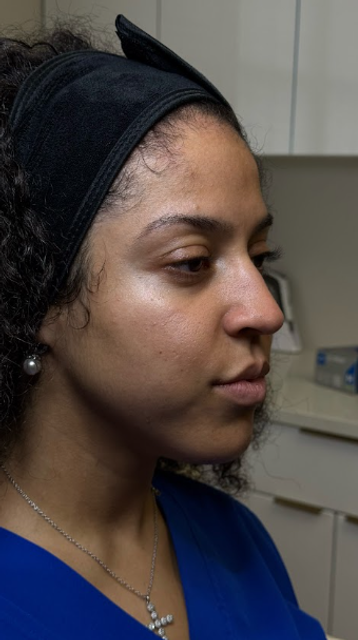 Side profile of a woman's face before a Glass Facial and dermaplaning treatment in Ajax