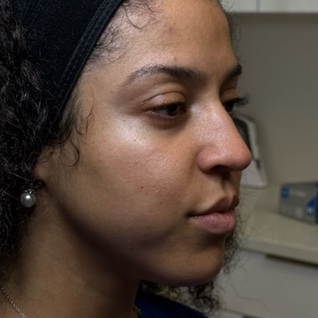 Side profile of a woman's face before a Glass Facial and dermaplaning treatment in Ajax
