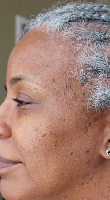 Close-up side profile of a patient with DPN spots on the cheek before removal treatment in Ajax